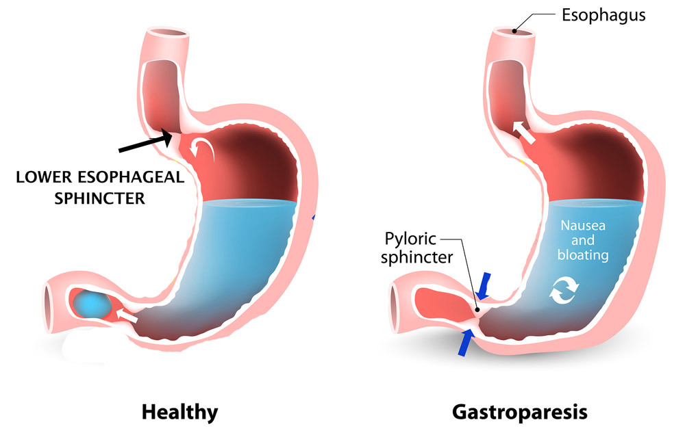 the LES and pyloric sphincter can cause laryngopharyngeal reflux disease