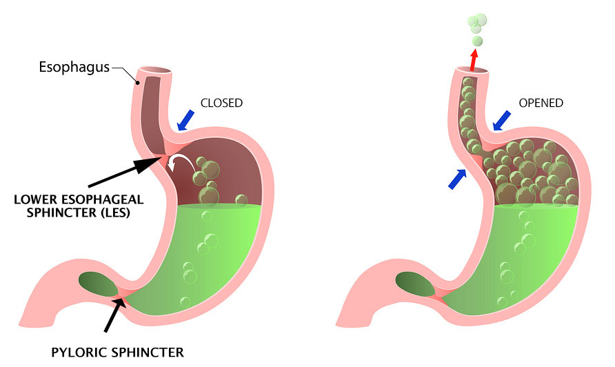 A defect LES lets reflux through